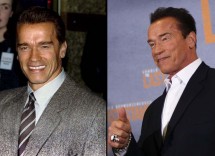 Arnold Schwarzenegger chirurgia estetica 5