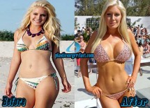 Heidi Montag Liposuction Before and After