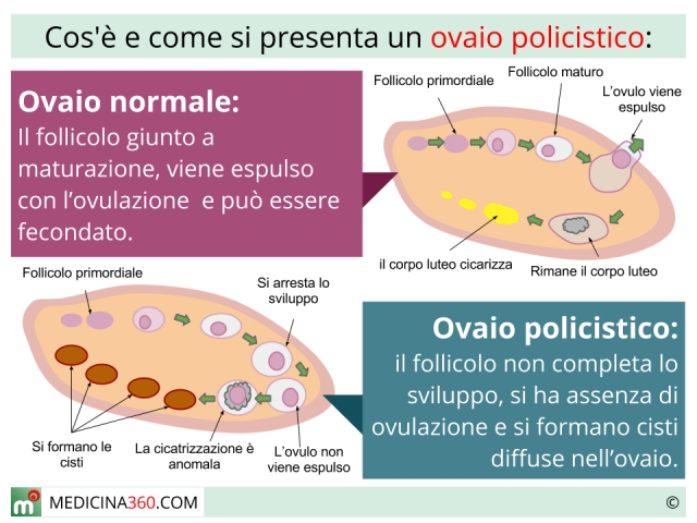 ovaio policistico 640x480