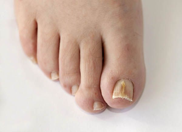 come riconoscere funghi unghie dei piedi