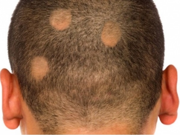 Come curare alopecia da stress