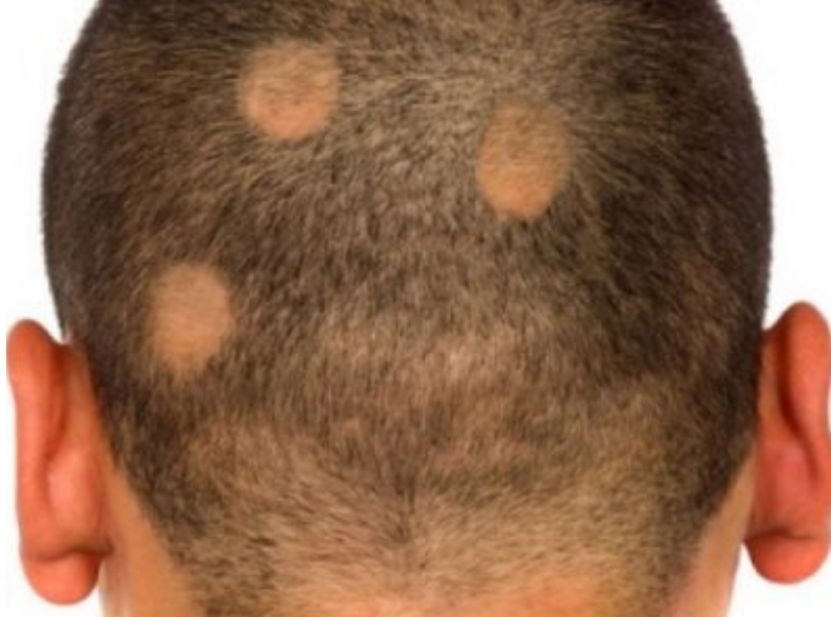 alopecia cura naturale