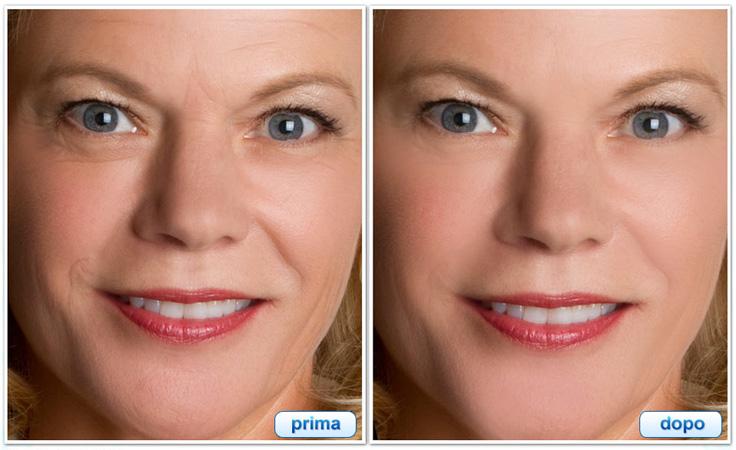 Prima dopo Fast lifting