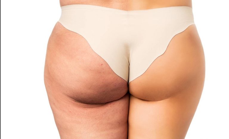 cellulite edematosa cosa è