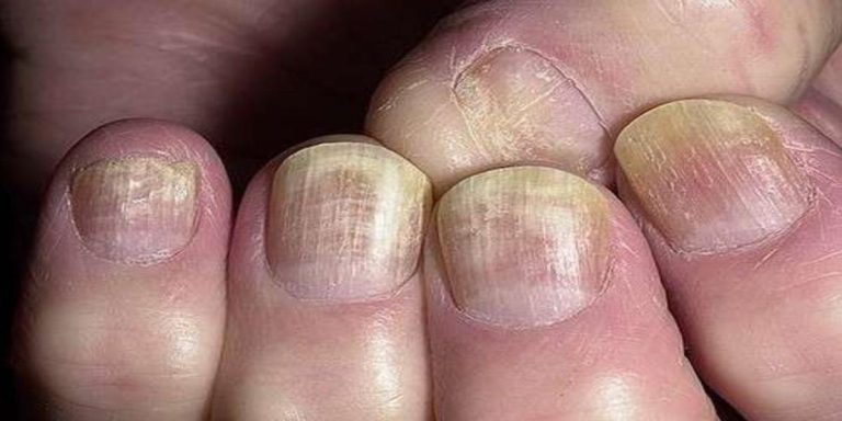 onicomicosi come curarla