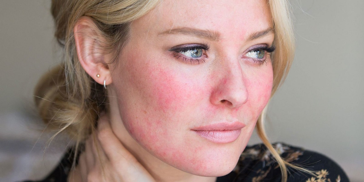 Rosacea: cos'è e come si cura