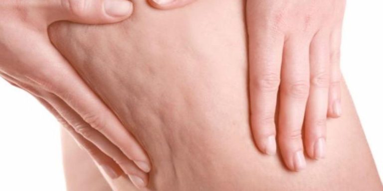 come eliminare la cellulite a casa