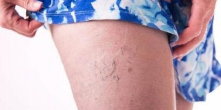 capillari rotti rimedi naturali