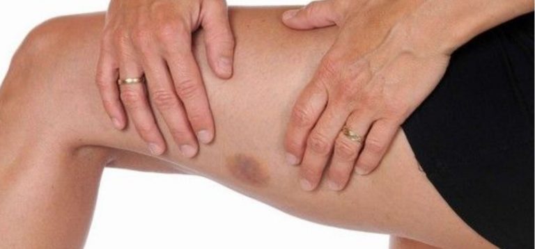 ematomi rimedi naturali