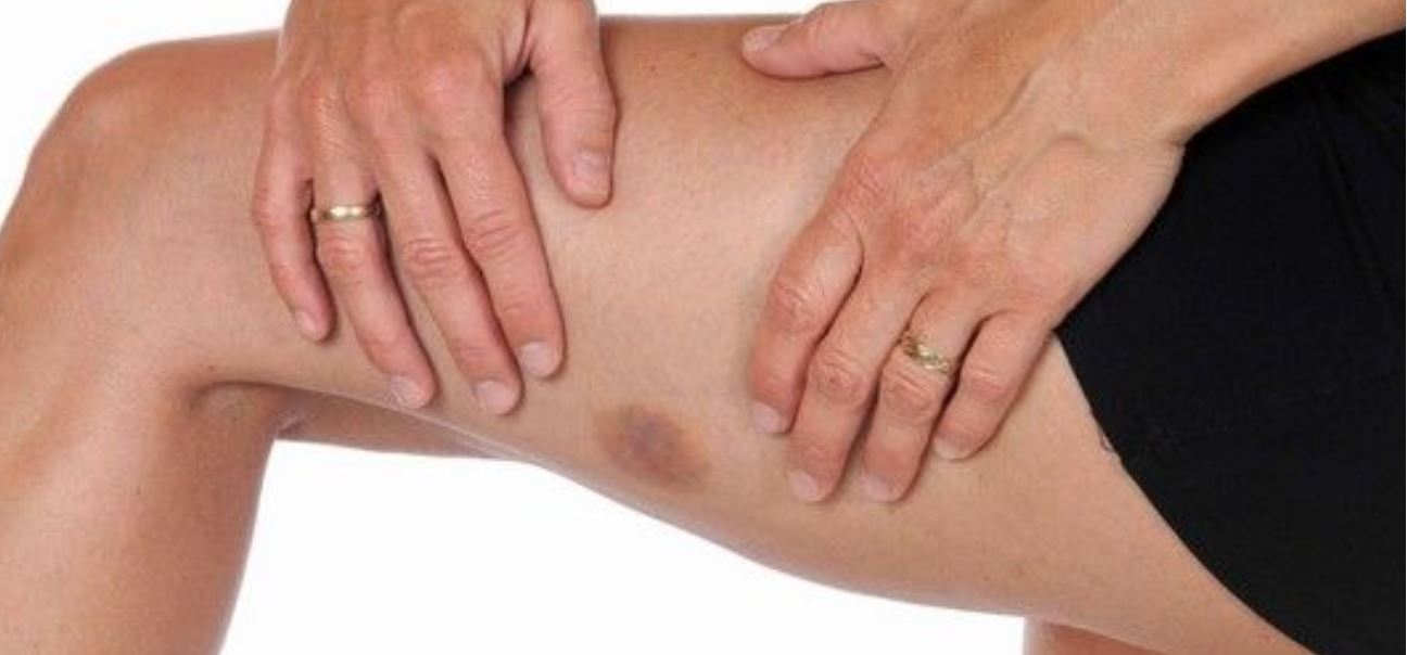 ematomi rimedi naturali