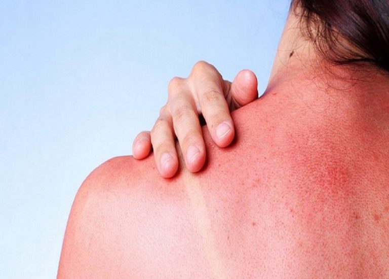 eritema solare come curarlo