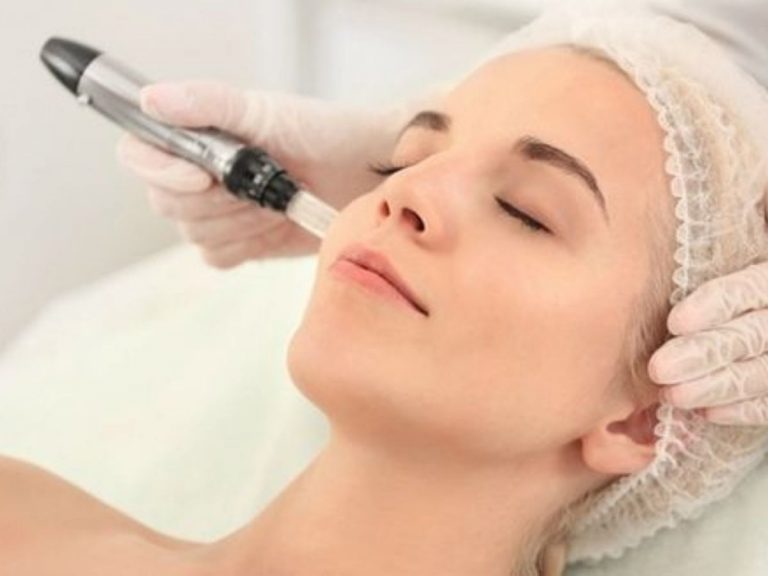 microneedling viso cosa e