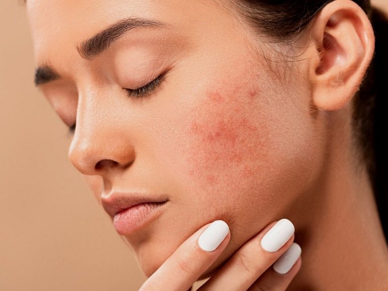 Come combattere l'acne sul viso