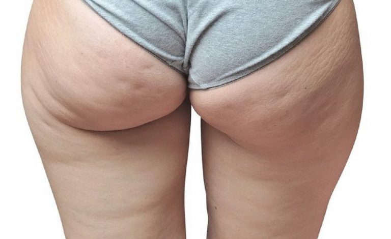 cellulite intolleranze alimentari