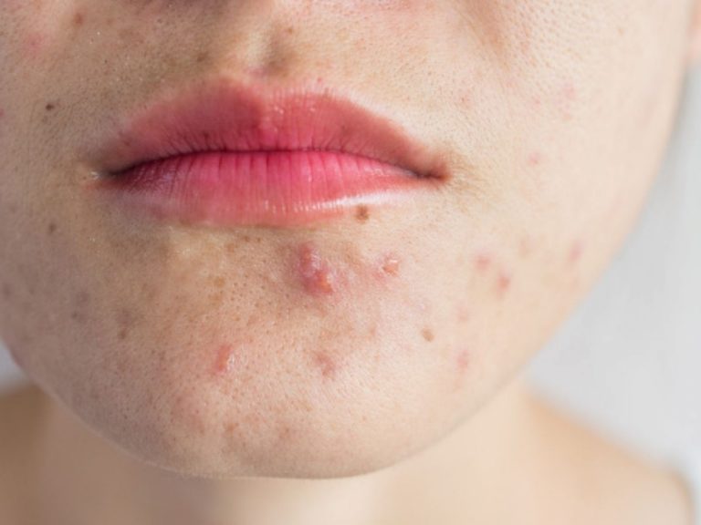 come combattere acne sul viso a tavola