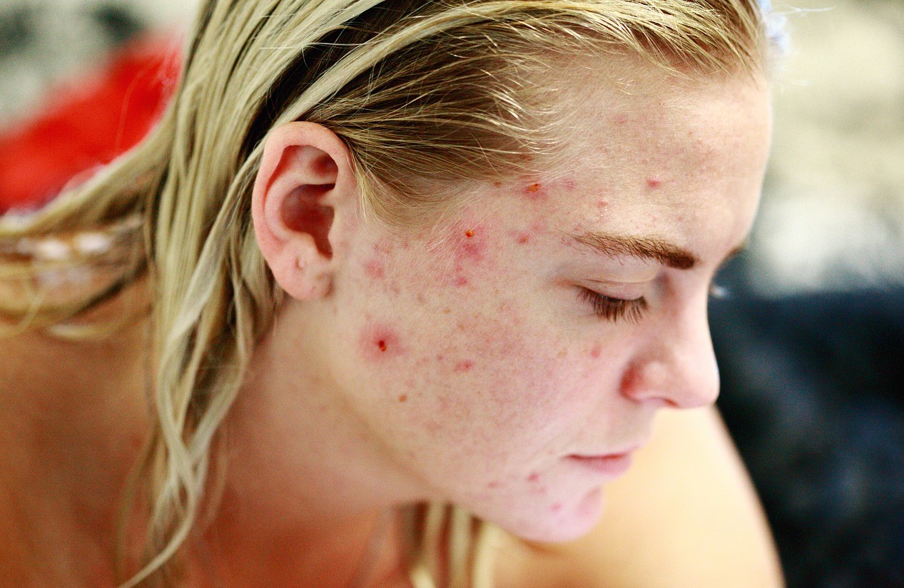 acne in età adulta rimedi