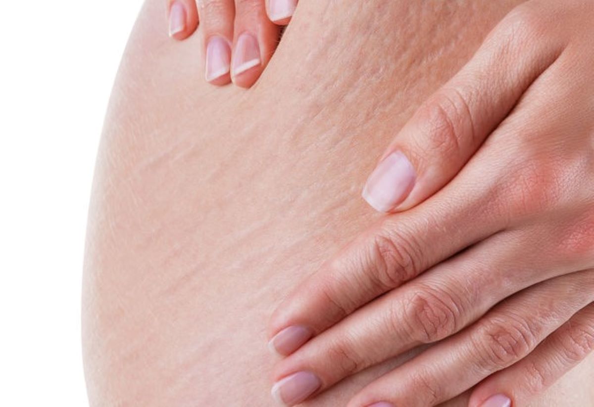 ritenzione idrica rimedi