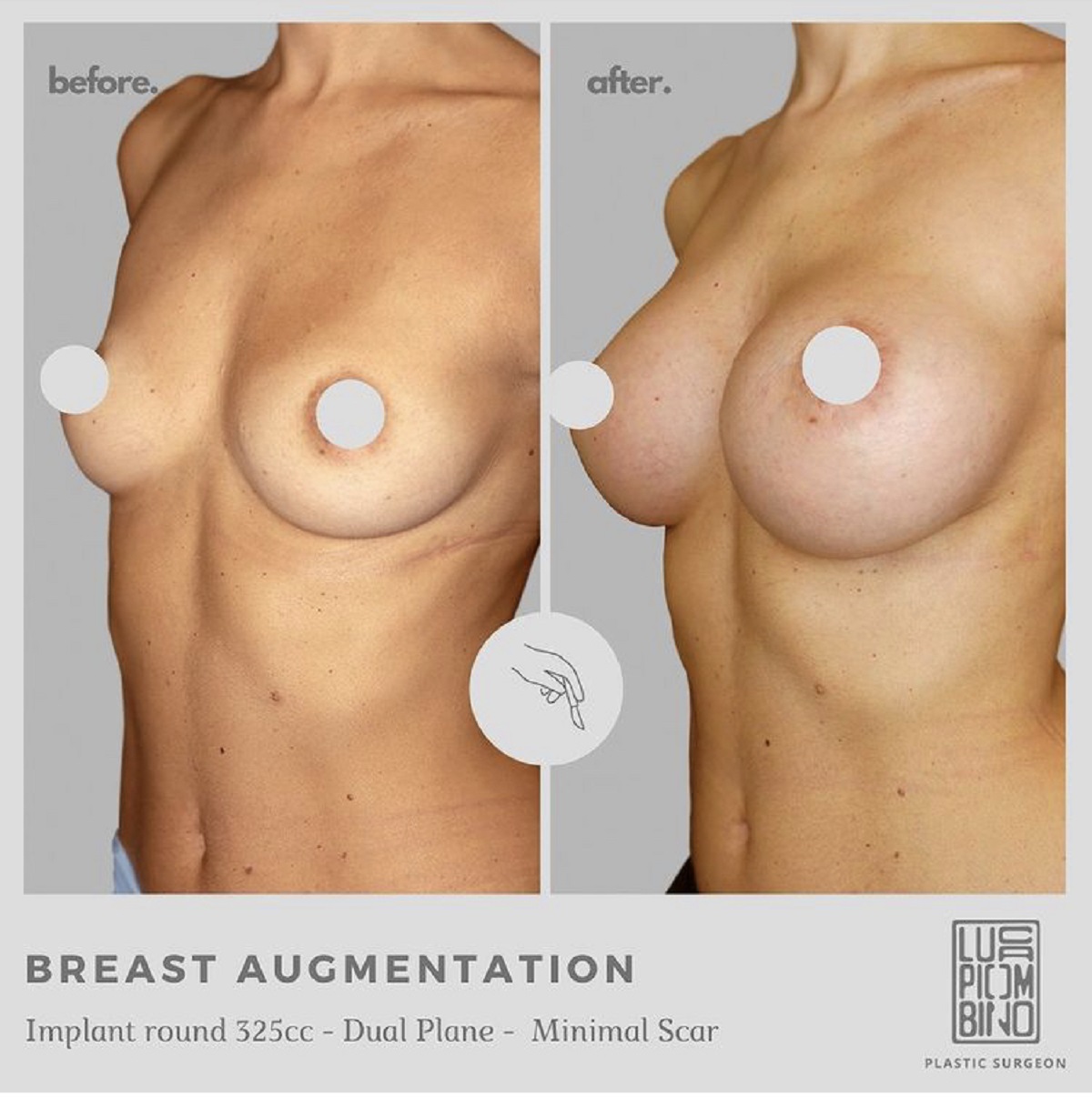 chirurgia estetica seno