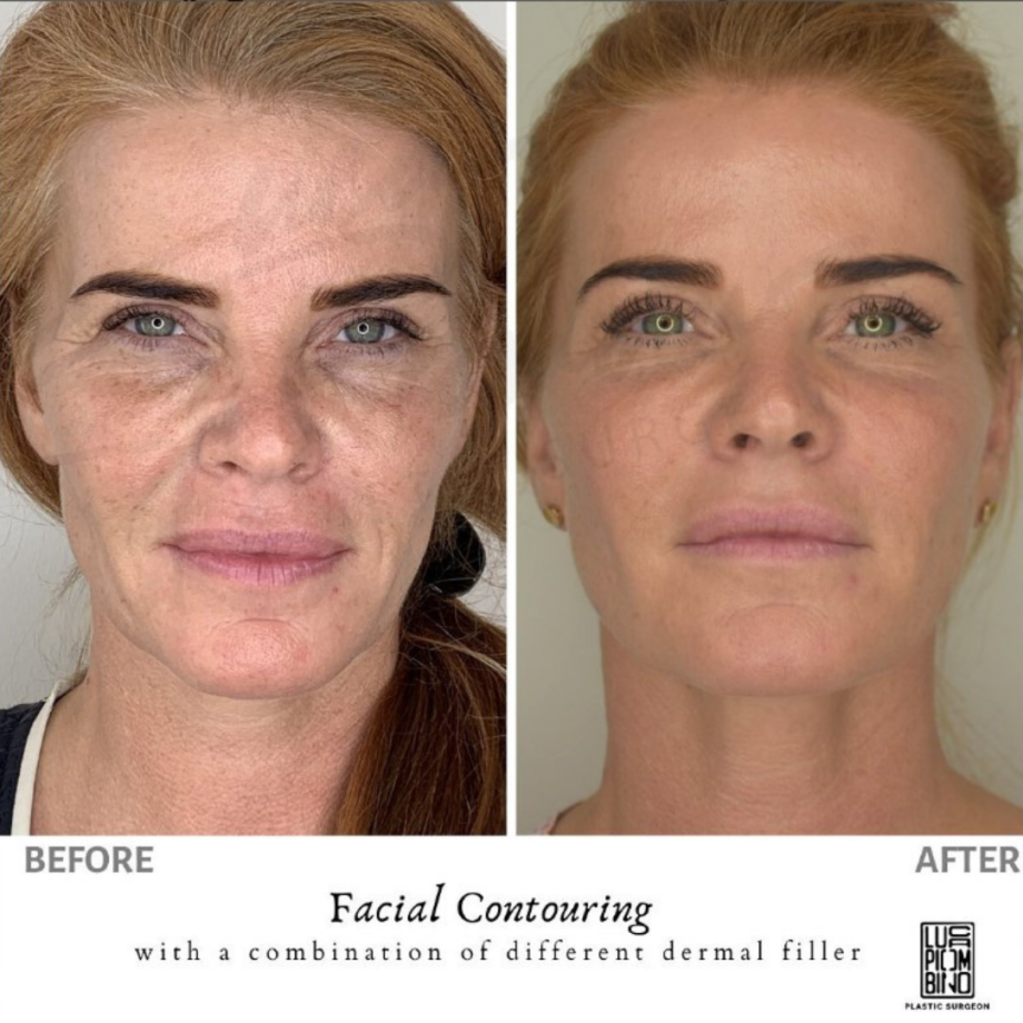 Facial contouring: prima e dopo