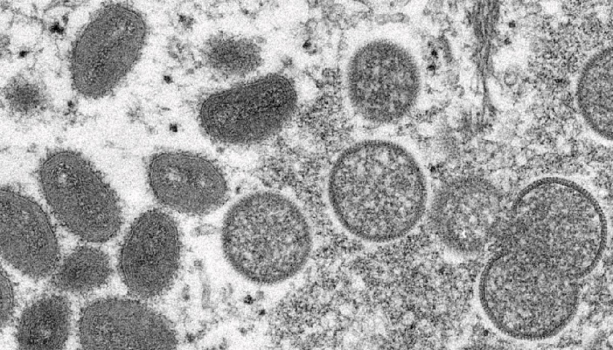 Negli Usa due bambini hanno contratto il monkeypox