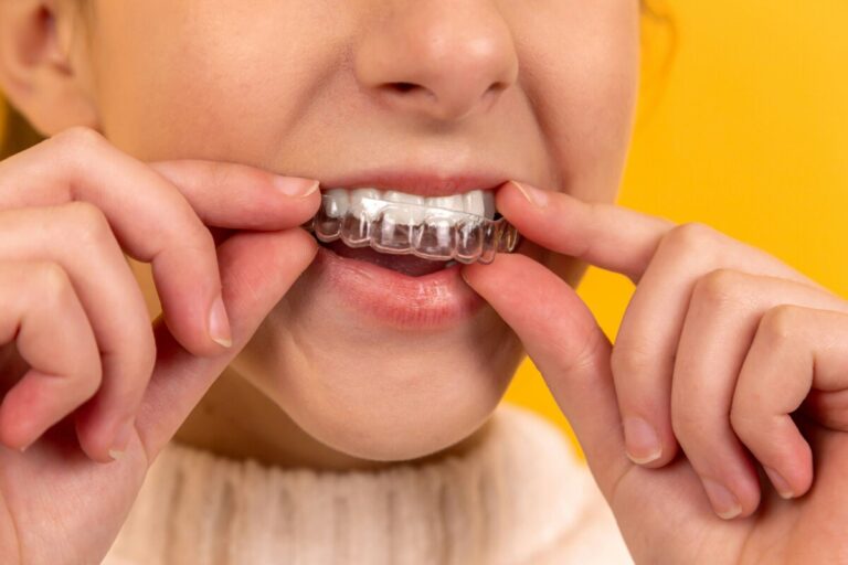 Faccette dentali: che cosa sono e quando usarle